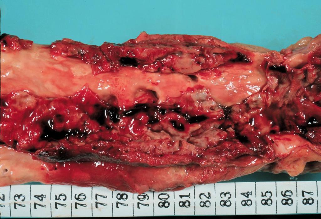 Fali thrombus aorta abdominalis-ban