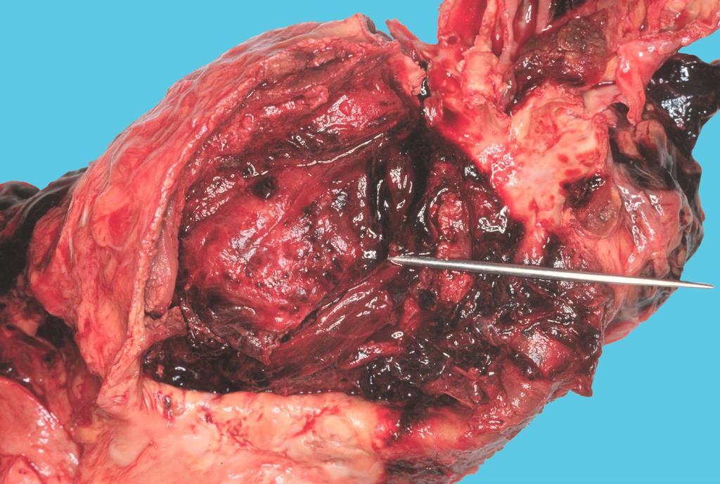 Fali thrombussal kitöltött aorta abdominalis aneurysma megrepedt