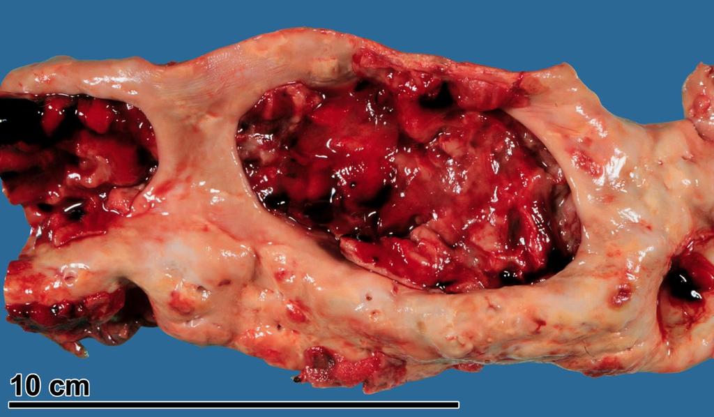 Aorta thoracalis-ban fali