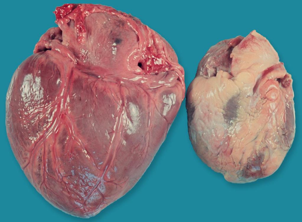 Hypertensiv szívbetegség: bal kamra (BK)