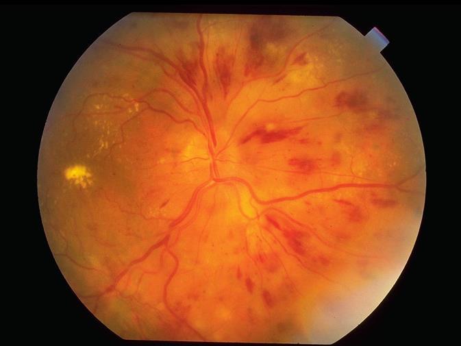 Hypertensiv retinopathia Ophtalmoscopiával a retina kisereinek a szűkülete észlelhető (fundus