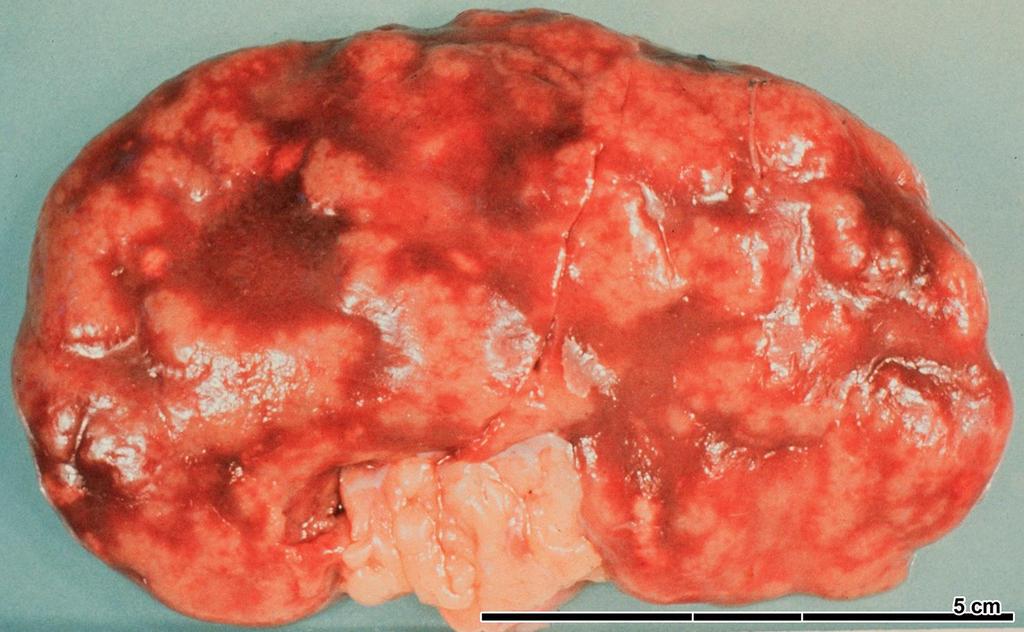 34 éves férfi. Nem kezelt malignus hypertonia.