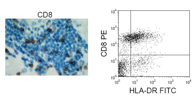 A MAIT és NKT receptorok jelenléte miatt megvizsgáltuk a tumorokat infiltráló sejtek fenotípusát. Több adat utal arra, hogy NKT és MAIT sejtek CD56 molekulát expresszálnak 8,9.