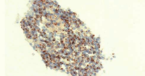 A metszetekben látható sejtek a citológiai mintákhoz hasonlóan mutatják a neuroendokrin sejtmorfológiát, ugyanakkor megfelelő mennyiségű sejt esetén további immunhisztokémiai reakcióval igazolható a