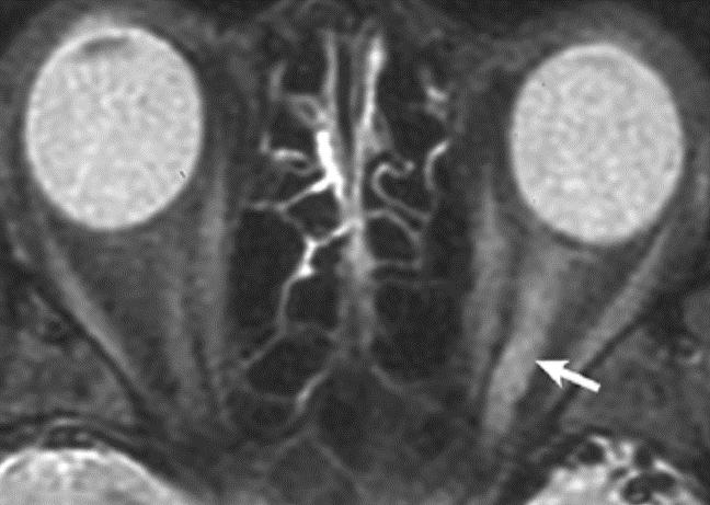 NMO-Spektrum betegség (Disease) (NMOSD) NMO-Spektrum betegségről (Disease) (NMOSD) akkor beszélünk, legalább egy NMO-ra jellemző tünet