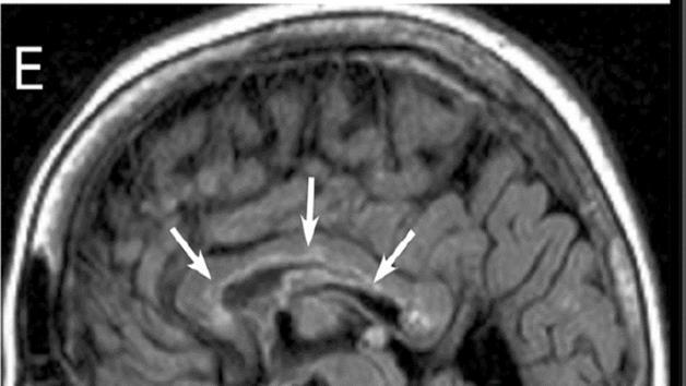 NMO-Spektrum betegség (Disease) (NMOSD) NMO-Spektrum betegségről (Disease)