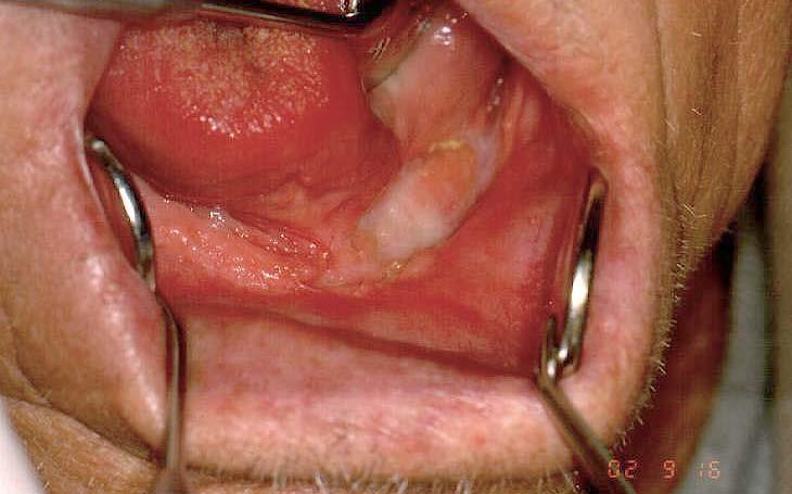 Gingiva tumor