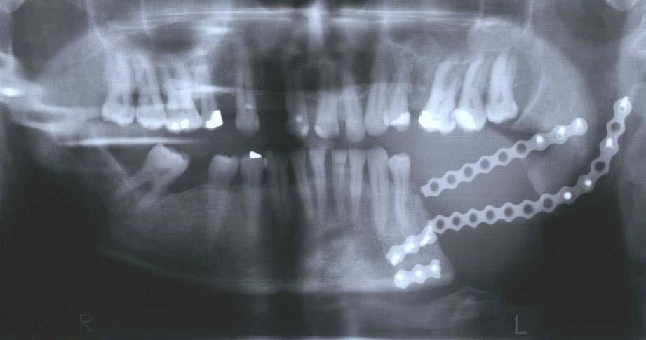 Mandibula defektus eltört