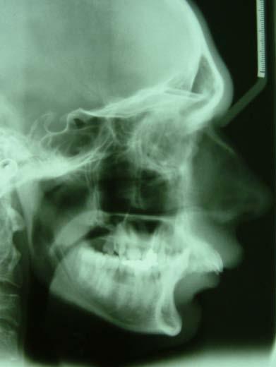 MANDIBULA DISTRACTIO