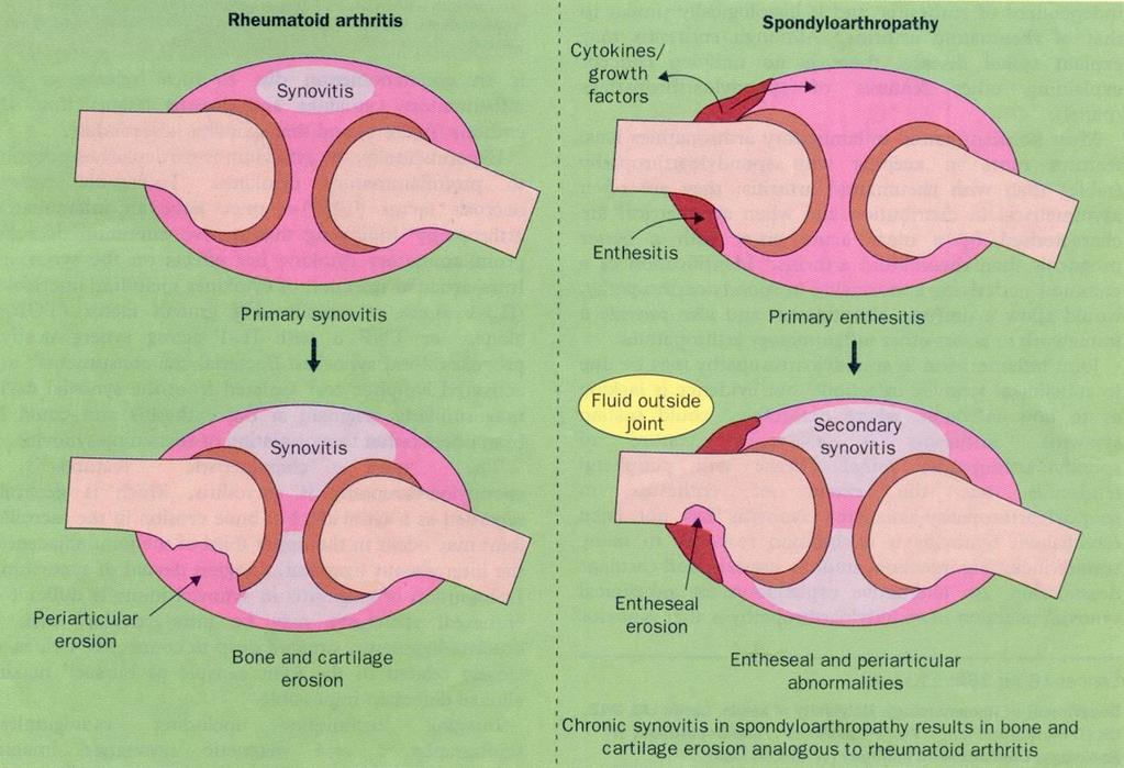 Enthesitis és synovitis Emery,