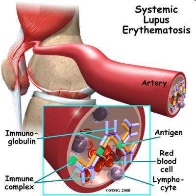 Szisztémás lupus erythematosus Poliszisztémás autoimmun betegség Antitest és immunkomplex okozta szervkárosodás 1895 William Osler: a nagy utánzó Az SLE ACR (Amerikai Reumatológusok Kollégiuma)