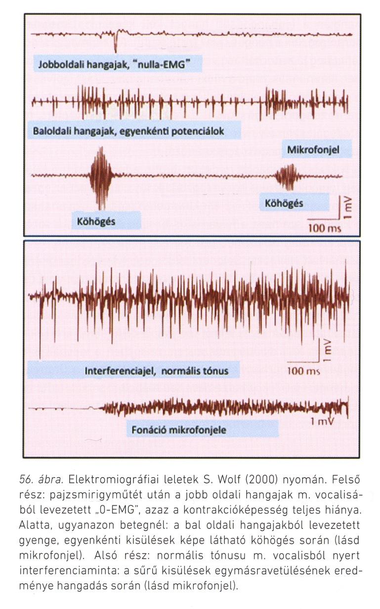 Elektromyográfia Hangajkak mozgáskorlátozottságának differenciáldiagnosztikája aryporc szubluxáció és