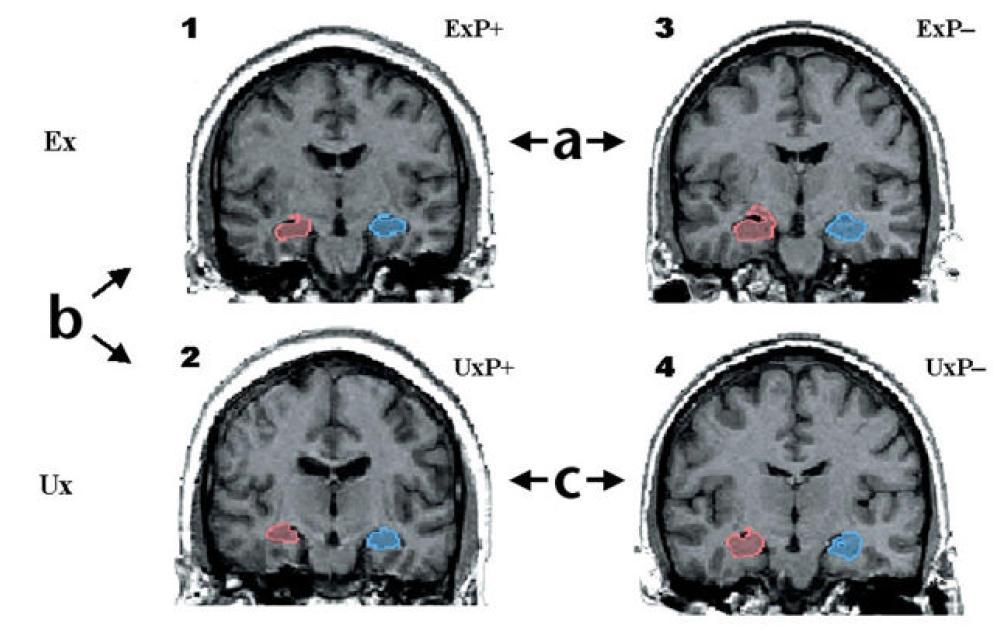 Hippocampus térfogatcsökkenés: Ok, vagy okozat?