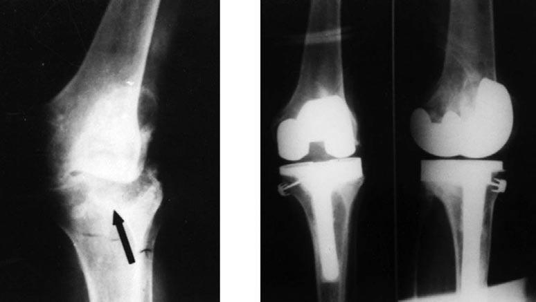 leti szeptikus gyulladás miatt 1998-ban antibiotikus spacer beültetéssel kétlépéses szeptikus revíziót végeztünk.