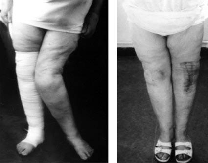 2. a ábra: Közvetlen műtét előtti kép, körülbelül 50 fokos valgus deformitás. 2. b ábra: Klinikai kontroll a műtét után 14 nappal. genocephalicus rögzítésre cserélték.