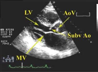 Aorta stenosis Lokalizáció szerint: Ø Subvalvularis : membran->hocm ØValvularis: - rheumás láz - degeneratív (elderly,