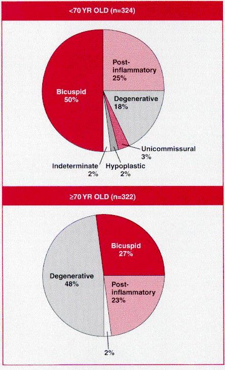 Etiologia <70 év: BICUSPIDALIS (50%) Degeneratív