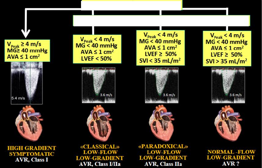 Az aorta stenosis egyszerűen diagnosztizálható vagy mégsem.