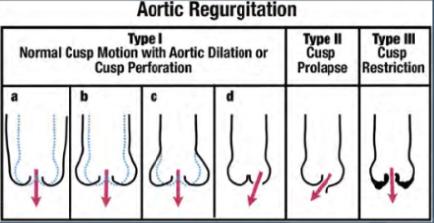 Az aorta regurgitáció - mechanizmus Mechanizmus: I.