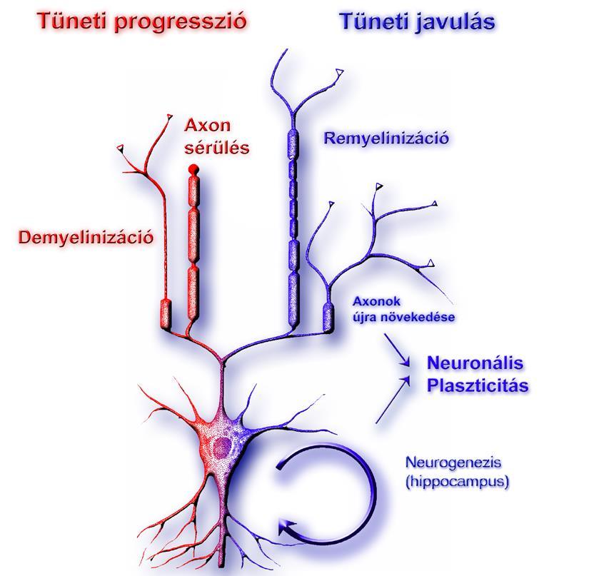 SM-ben a tüneti javulás oka remyeliniziáció, és