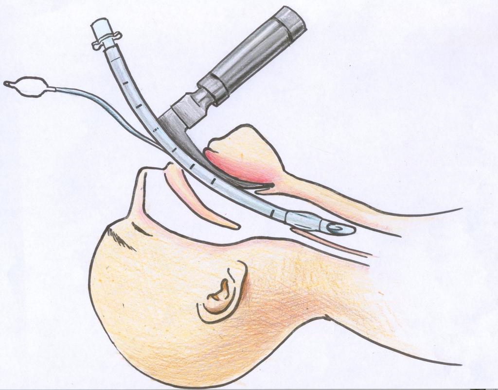 Intubálás