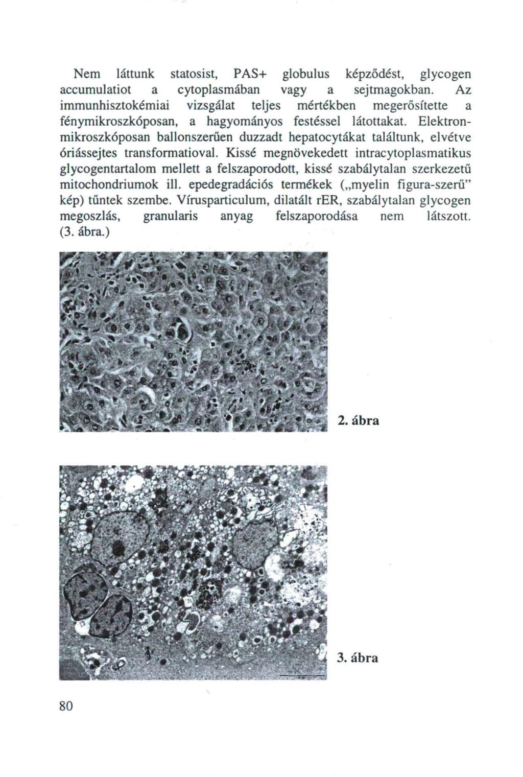 Nem láttunk statosist, PAS+ globulus képződést, glycogen accumulatiot a cytoplasmában vagy a sejtmagokban.