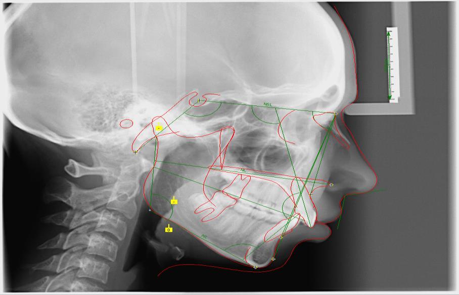 Kefalometriai analízis (Hasund,Onyx Ceph) Arctípus: orthognath Bazális anomália karaktere: Distalis bazális viszony ANB