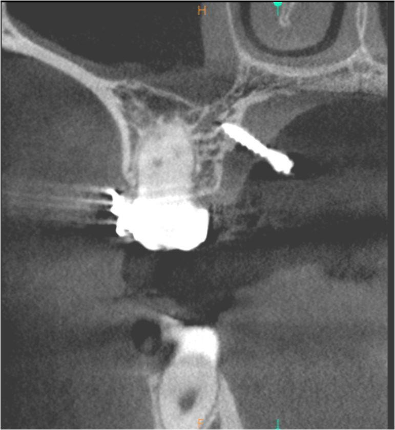CBCT felvétel az implantátumról