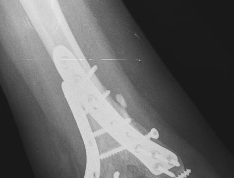 Humerus