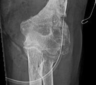 Humerus