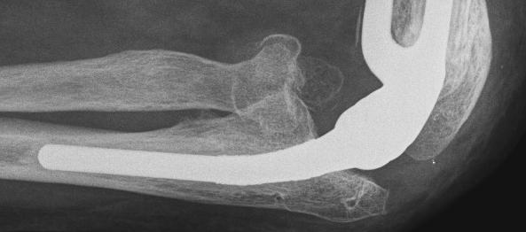 arthrosis töréskezelés után ízületi kezelés túlsúly