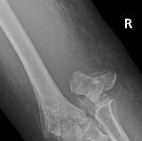 Coronal