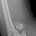 Fractures
