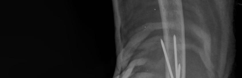 Humerus