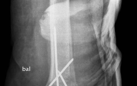Humerus