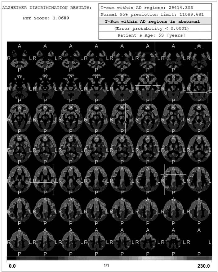 5. ábra. A beteg PET/CT felvétele Irodalom BOERSMA, P. WEENINK, D. (2010): Praat: doing phonetics by computer (version 5.1). http://www.praat.org/ (A letöltés ideje: 2011. március 5.). GORNO-TEMPINI, M.