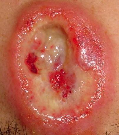 Syphilis, lues kórokozó Treponema pallidum Csaknem kizárólag szexuális úton Granulomatosus gyulladás Szerzett Primer: ulcus durum, bubo indolens Secunder: