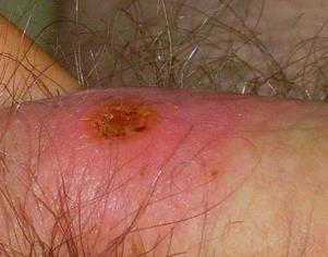 aorta felszálló szakasza Neuoro syphilis tabes dorsalis, paralysis prgr.