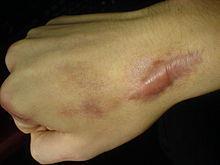 Keloid Kontraktura A granulációs
