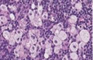 Macrophagok morfológiai típusai A fibrosis mediátorai