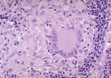 Haemosiderin-tartalmú Epitheloid sejtek Óriássejtek Pleuritis