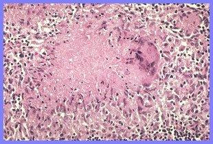 TBC Granulomatosus gyulladások Mycobacterium tuberculosis: 2-10um hosszú,