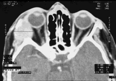 Adenoid cysticus carcinoma (cylindroma) Könnymirigy leggyakoribb