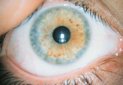 fibroma molle, os sphenoidale dysplasia pulsaló exophthalmus