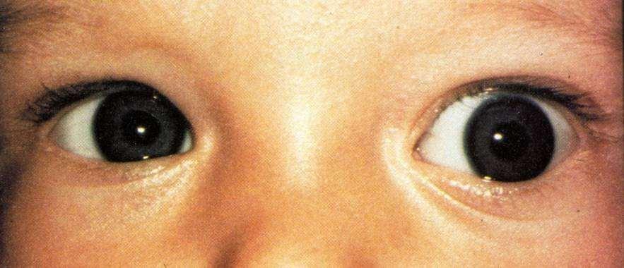 Nervus opticus glioma Legtöbbször gyermekekben alakul ki az