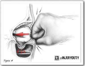 Blow out fractura Anamnezis