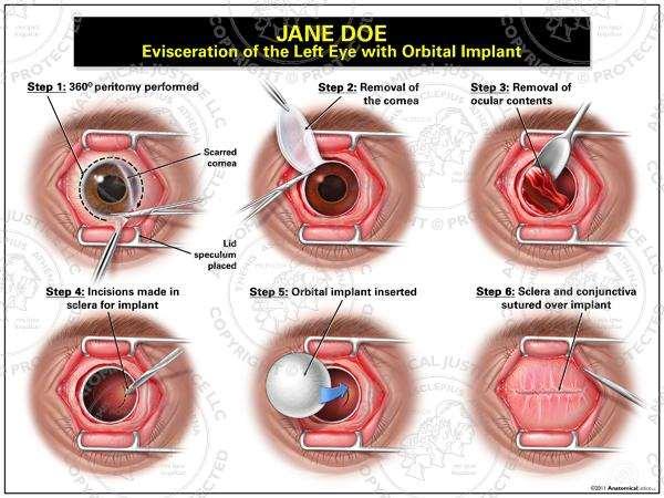 EVISCERATIO A szemgolyó belső részeinek eltávolítása a sclera és az extraocularis