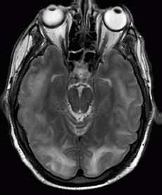 NEUROLÓGIAI PROBLÉMÁK Incidencia 47% Görcsök /calcineurin inhibitor gyógyszerszint/ Intracerebrális vasoconstrictio-, ischemia, hypertonia EEG