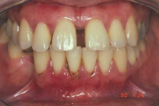 A parodontitis oka a fogak felszínén megtapadó dentális plakk. A dentális plakkból közel 400 különböző baktériumtörzs tenyészthető ki.