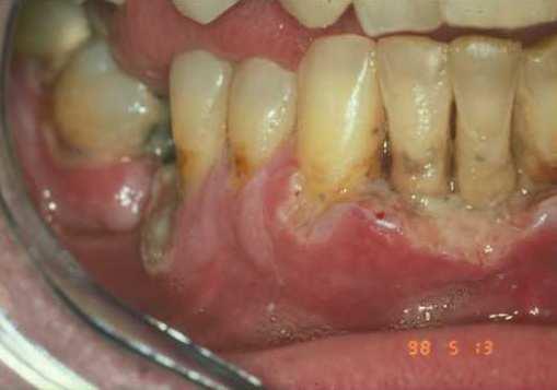 BACTERIAEMIA súlyos destructiv parodontitisben igazolt a bacterialis invázió Allenspach-Petrzilka GE, Guggenheim B.